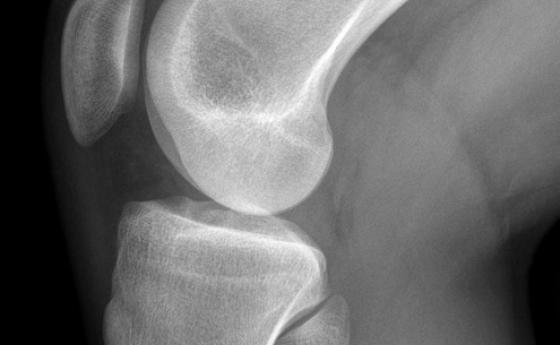 Стероидните инжекции за облекчаване на болката могат да влошат артрита на коляното