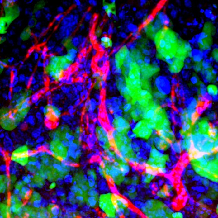 Наночастици в ракови клетки в мозъка, снимка: Wikimedia Commons