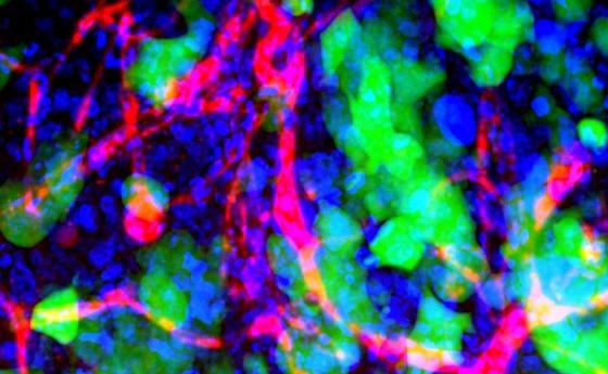 Наночастици унищожават раковите клетки в мозъка