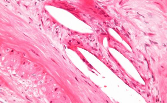 Учени установиха причините за страничните действия на статините